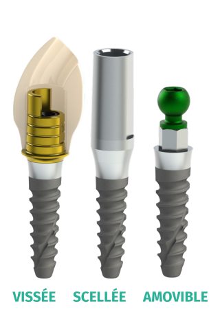 mini-implant-protheses