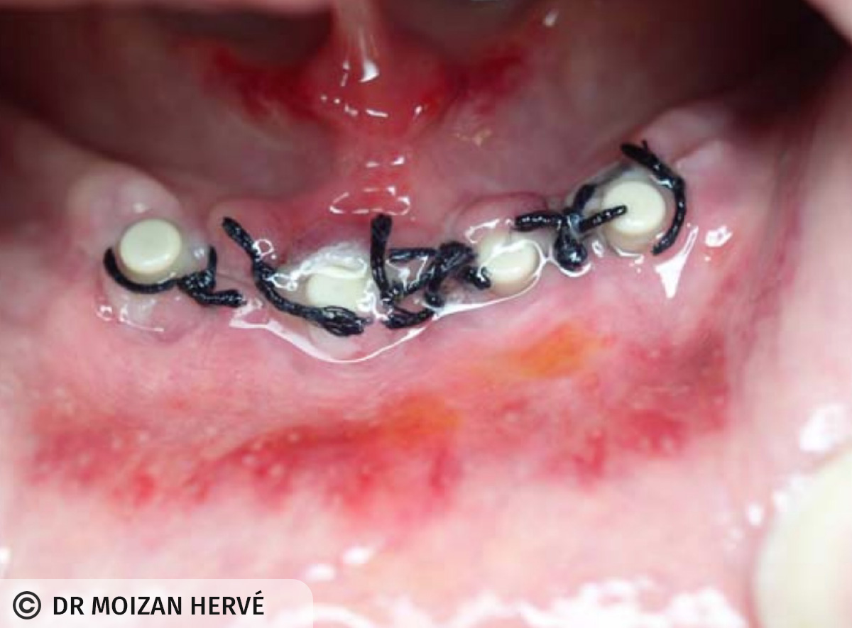 Vue endobuccale à J+3 (hématome vestibulaire)