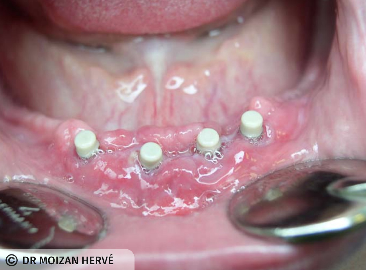 Capuchons de cicatrisation à J+7 (dépose sutures)